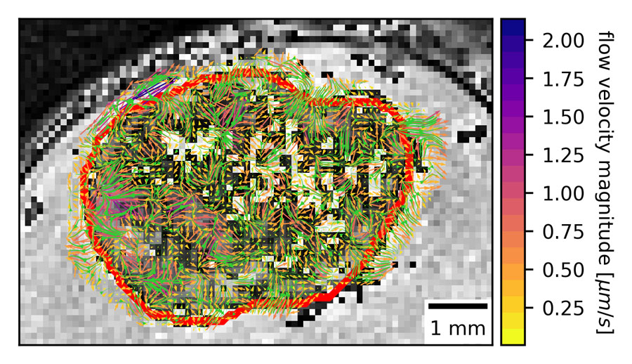 MRI with contrast shows heterogenous interstitial fluid flow in glioblastoma. The tumor border is outlined in red. <br/>CREDIT: Kingsmore et al. MRI with contrast shows heterogenous interstitial fluid flow in glioblastoma. The tumor border is outlined in red. Credit: Kingsmore et al.