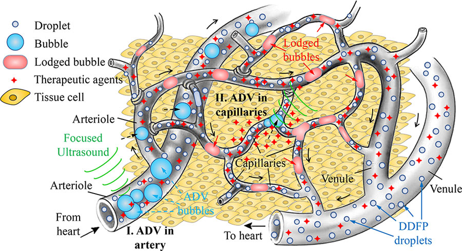 Shown here is a gas embolotherapy scenario. After the droplets were injected intravenously with or without therapeutic agents (e.g., chemotherapeutics or genes) and subsequently transported to the tumor microcirculation by blood flow, bubble formation was induced by ADV on demand.  Credit: Dui Qin/Xi’an Jiaotong University