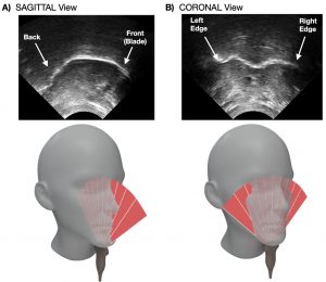 These images show the real-time visual feedback of the tongue in sagittal (A) and coronal (B) planes, and for each condition the orientation of the ultrasound transducer is shown below. CREDIT: Guillaume Barbier, Ryme Merzouki, Mathilde Bal, Shari R. Baum, and Douglas M. Shiller