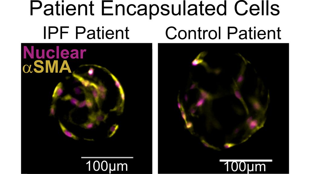 The Wood Lab's high-throughput 3D culture workflow allows encapsulation of patient-sourced cells and the study of their fibrotic function. CREDIT: Katherine Cummins