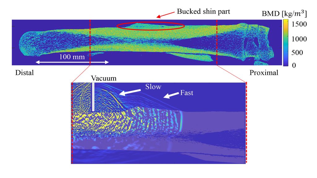 Top: Cross-sectional view of the bone mineral density distribution in the metacarpal bone measured by computed tomography. Bottom: Simulated wave propagation in bone. CREDIT: Miyashita et al.