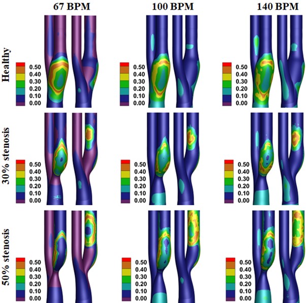 Contours of oscillatory shear index (OSI) on healthy, 30% stenosis, and 50% stenosis carotid arteries for the normal (67 beats per minute), moderate (100 bpm), and high exercise (140 bpm) heart rates. Credit: Khan et al.