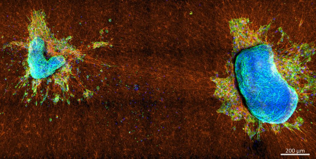 Two malignant mixed mullerian tumor explants on collagen network. Both tumor pieces adhered to the collagen network and started pulling on the collagen fibers, which prompted extensive collagen displacements and alignments, alongside cell escape of cells with a dominant stress fiber-based contractility. The sharp and smooth boundary structure of both pieces further indicates a strong tissue surface tension that hinders cell escape for cells with a dominant cortical contractility. Credit: Steffen Grosser, Frank Sauer, and Eliane Blauth