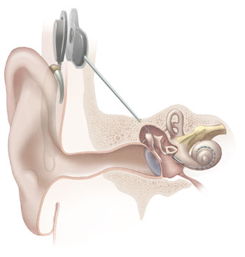 An illustration of a cochlear implant from the National Institute on Deafness and Other Communication Disorders at the National Institutes of Health. Credit: NIHLicense information: This image is a work of the National Institutes of Health, part of the United States Department of Health and Human Services, taken or made as part of an employee’s official duties. As a work of the U.S. federal government, the image is in the public domain. (https://commons.wikimedia.org/wiki/File:Cochlear_implant.jpg)