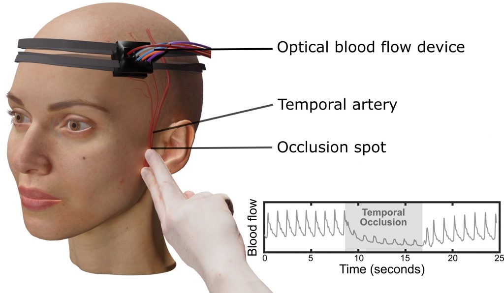 Setup of the laser speckle contrast optical spectroscopy system used to monitor scalp and brain blood flow during temporary blockage of a major scalp artery near the temple. Credit: Huang et al.
